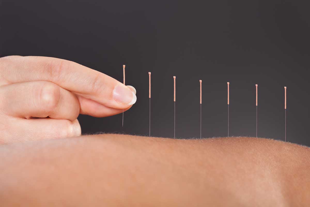 bigstock-acupuncture-treatment-63623578