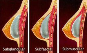 protese-silicone