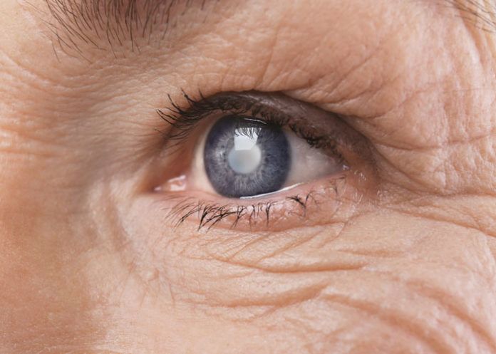 glaucoma
