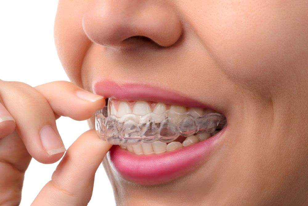 speed-up-invisalign